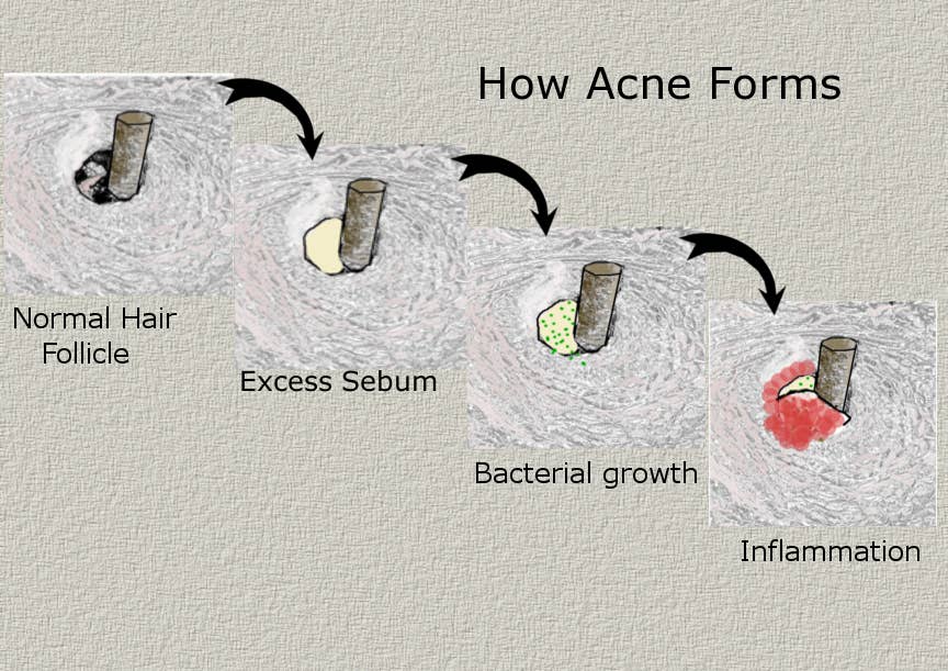Formation of Acne: Genetic vs. Environmental Causes - Owlcation
