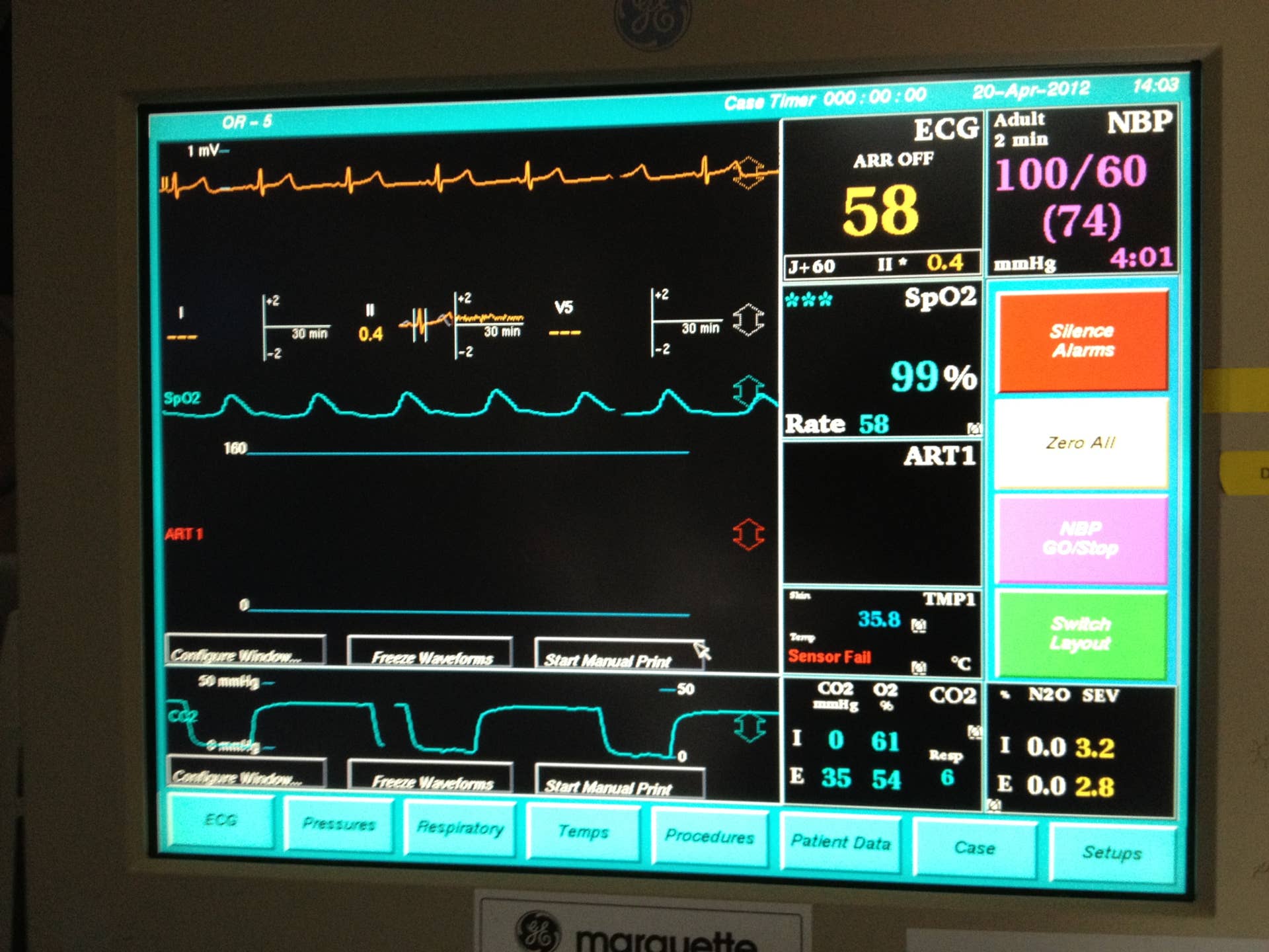 How to Read a Ventilator Monitor: Essential Tips for Beginners